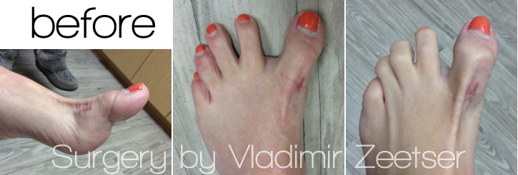 Before Hallux Varus