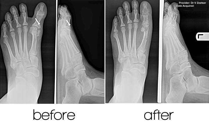 FastForward Varus Repair Before and After